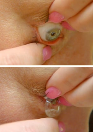Lens-Removal-photos_SynergEyes-VS_Finger-Method_a